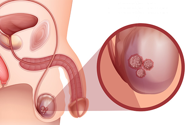 Cancer du testicule : comment réaliser l'autopalpation